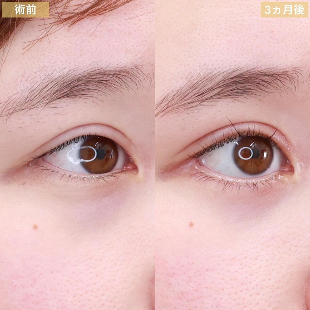 グラマラスライン（タレ目形成）/目尻切開術/下眼瞼脱脂術（目の下のたるみ取り・目の下の脂肪ふくらみ取り）の症例写真 施術前後 3ヵ月