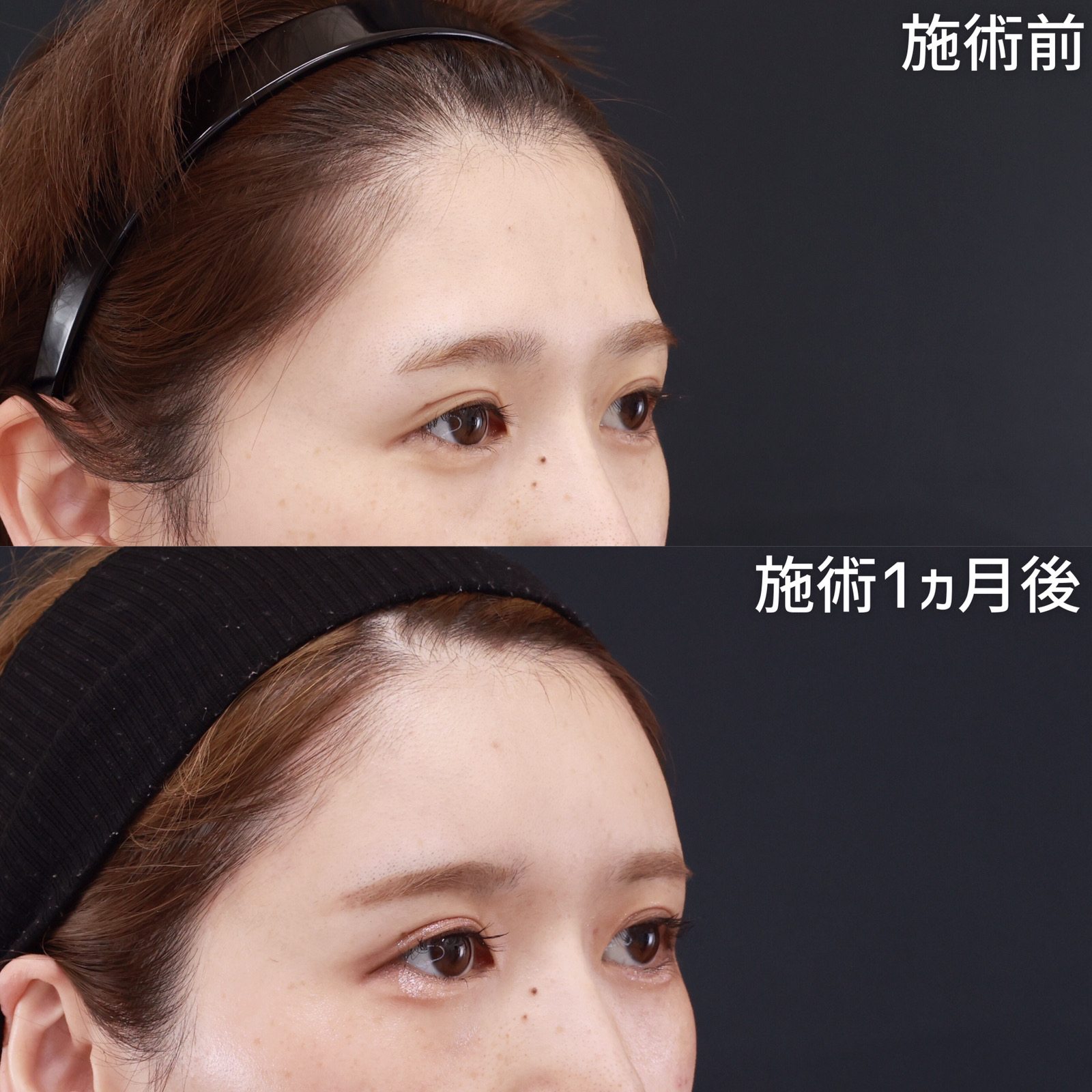 顔の脂肪注入(コンデンスリッチフェイス)/おでこの脂肪注入（オルチャンデコ形成）の症例写真 施術前後 