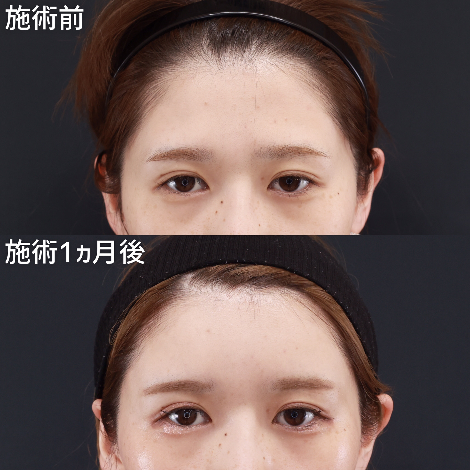 顔の脂肪注入(コンデンスリッチフェイス)/おでこの脂肪注入（オルチャンデコ形成）の症例写真 施術前後 
