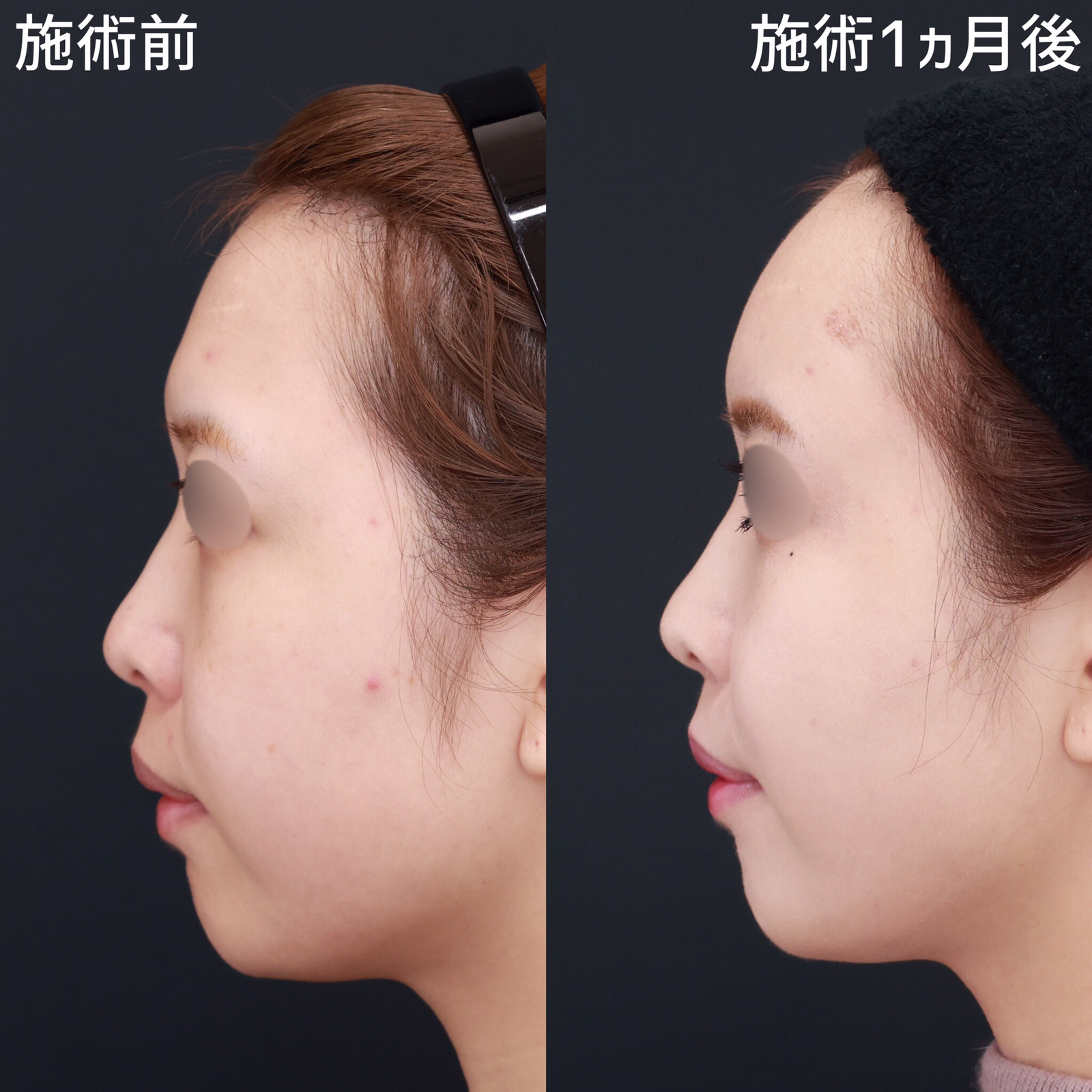 TAC式 ツヤ肌コラーゲンリフト®/顔の脂肪注入(コンデンスリッチフェイス)/おでこの脂肪注入(オルチャンデコ形成)の症例写真 施術前後 1ヵ月