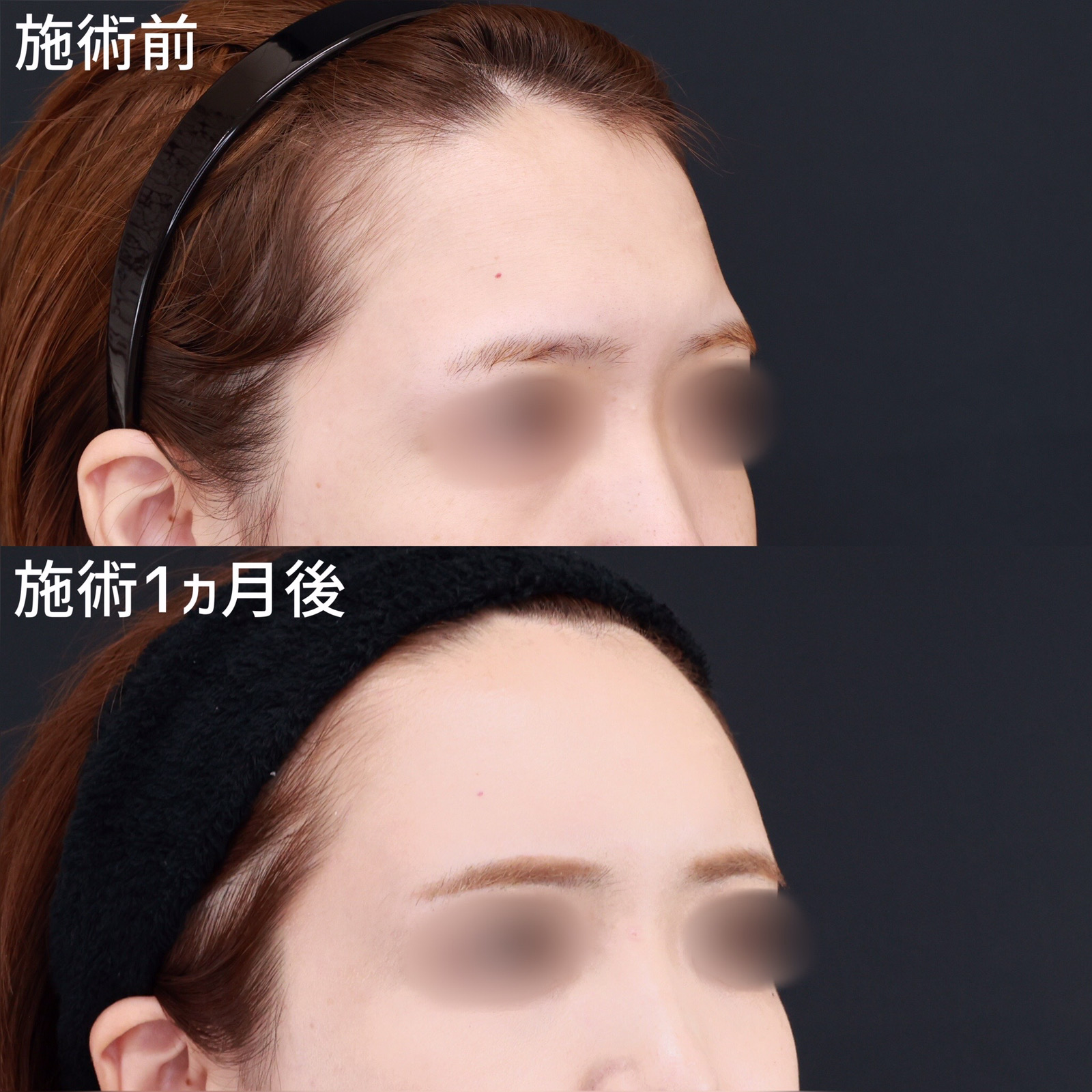 TAC式 ツヤ肌コラーゲンリフト®/顔の脂肪注入(コンデンスリッチフェイス)/おでこの脂肪注入(オルチャンデコ形成)の症例写真 施術前後 1ヵ月