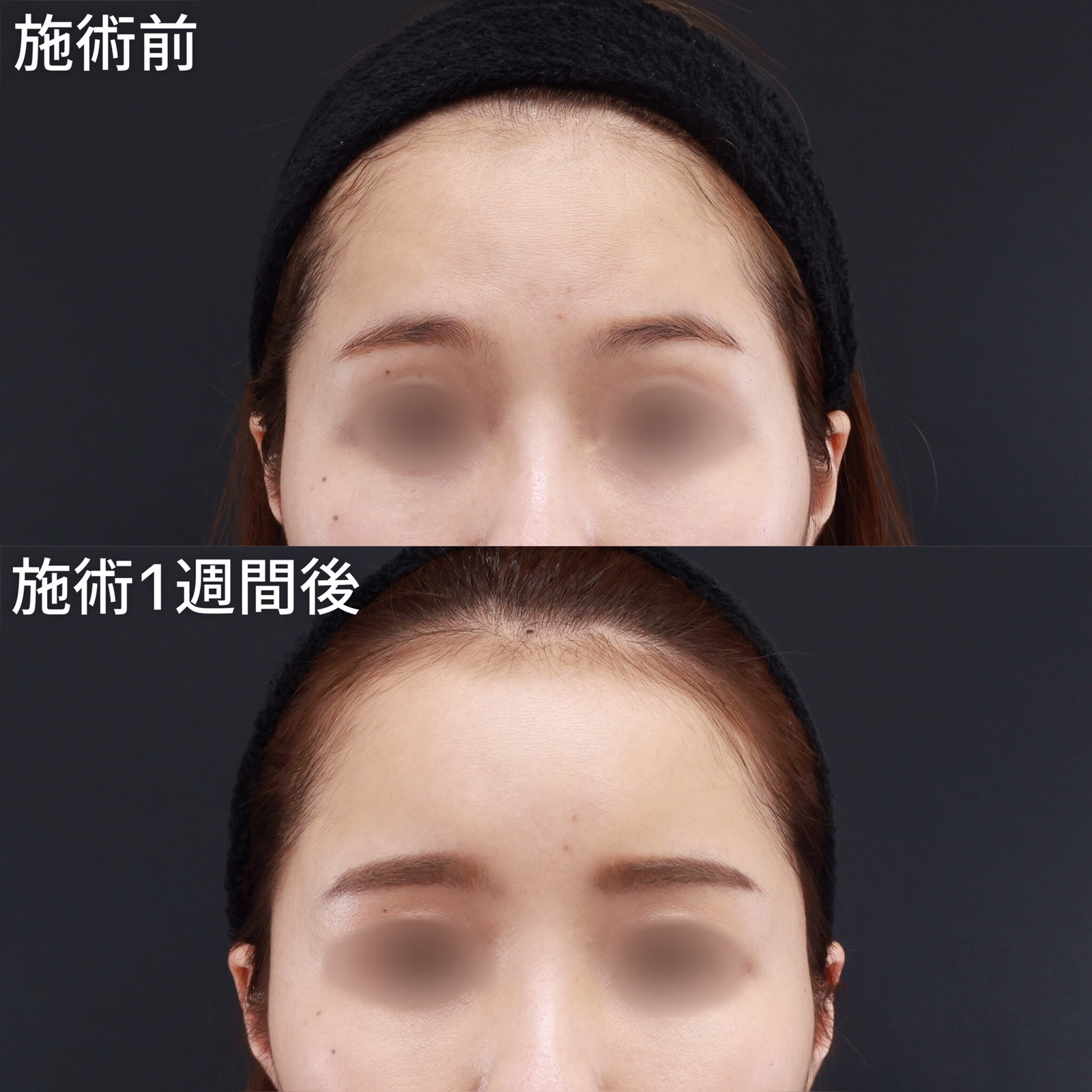 おでこの脂肪注入(オルチャンデコ形成)/顔の脂肪注入(コンデンスリッチフェイス)の症例写真 施術前後