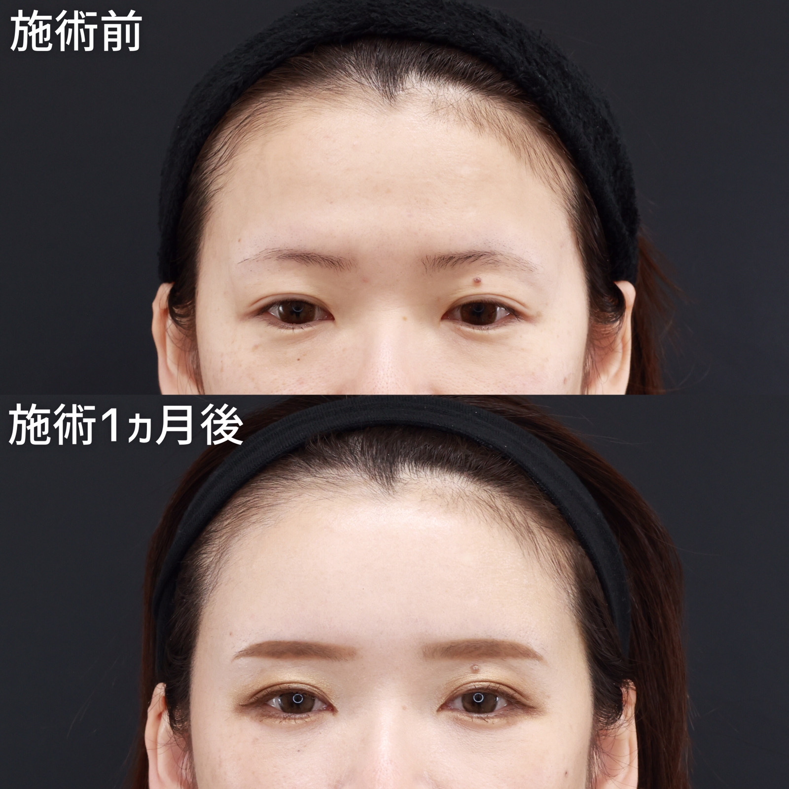 おでこの脂肪注入（オルチャンデコ形成）/顔の脂肪注入(コンデンスリッチフェイス)の症例写真 施術前後 