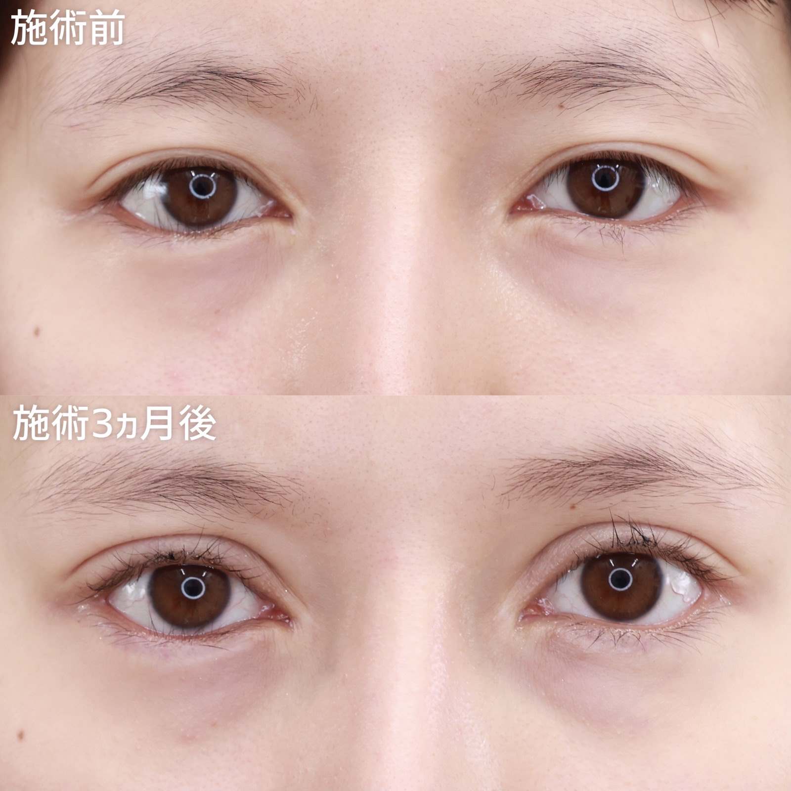 眼瞼下垂の症例画像