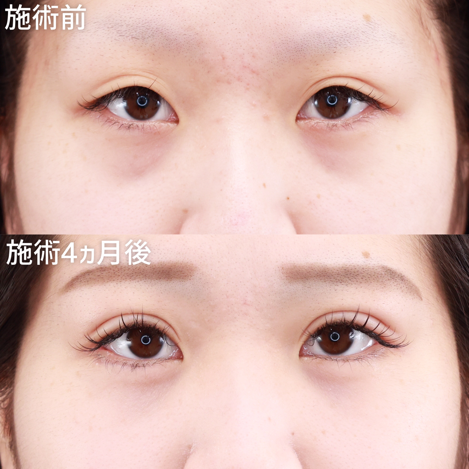 クイックコスメリング/下眼瞼脱脂術(目の下のたるみ取り・目の下の脂肪ふくらみ取り)/顔の脂肪注入(コンデンスリッチフェイス)の症例写真 施術前後