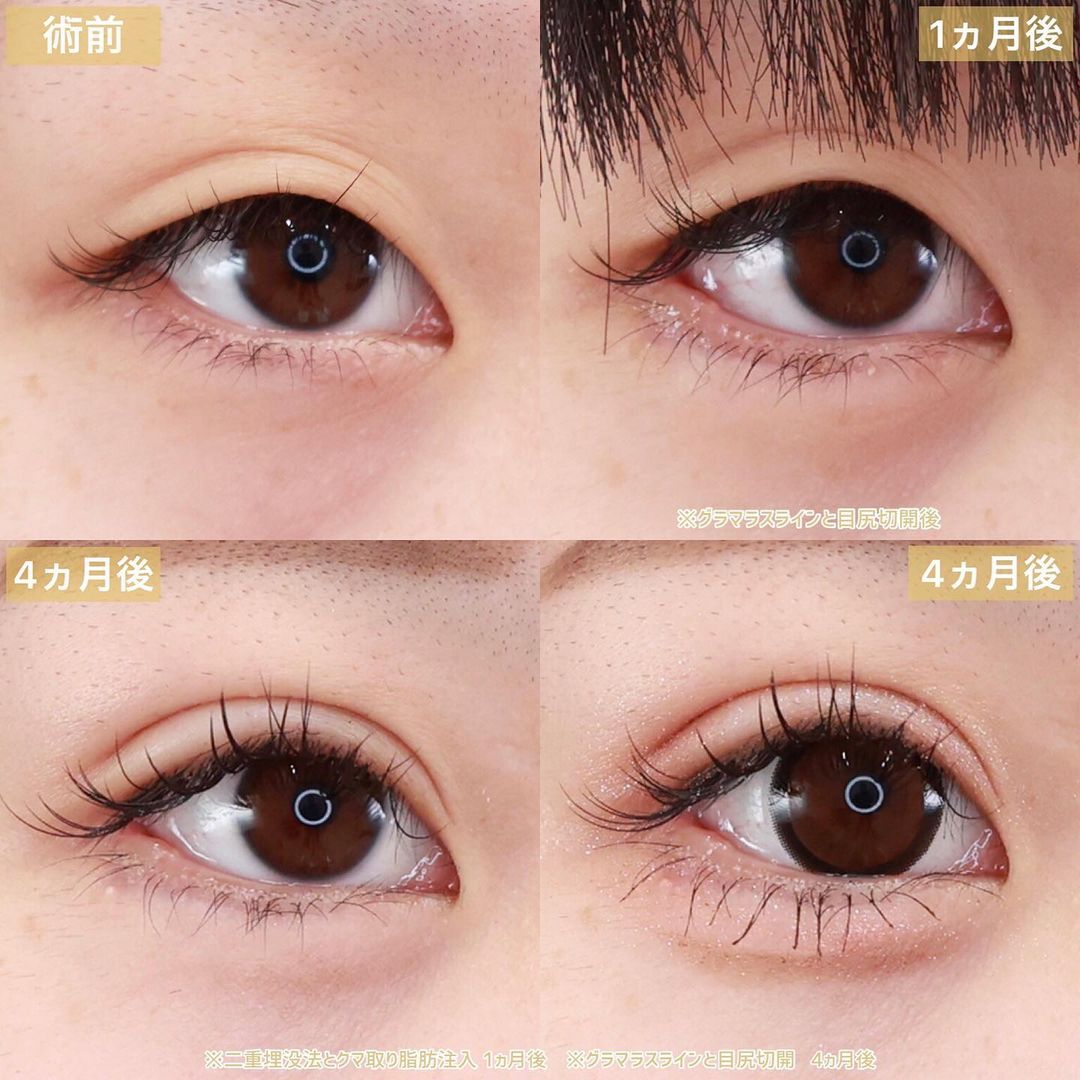 クイックコスメリング/下眼瞼脱脂術(目の下のたるみ取り・目の下の脂肪ふくらみ取り)/顔の脂肪注入(コンデンスリッチフェイス)の症例写真 施術前後