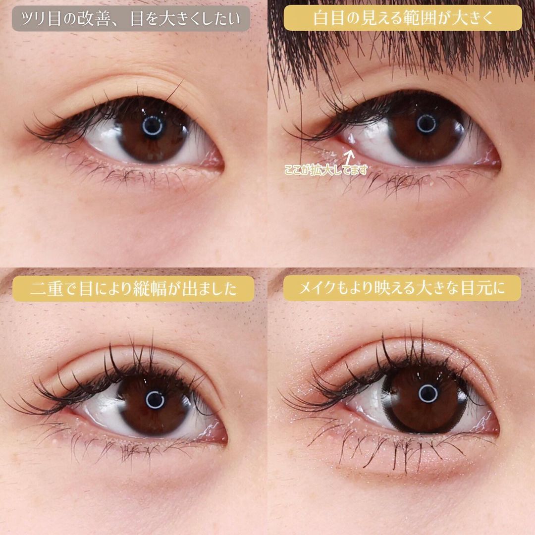 クイックコスメリング/下眼瞼脱脂術(目の下のたるみ取り・目の下の脂肪ふくらみ取り)/顔の脂肪注入(コンデンスリッチフェイス)の症例写真 施術前後