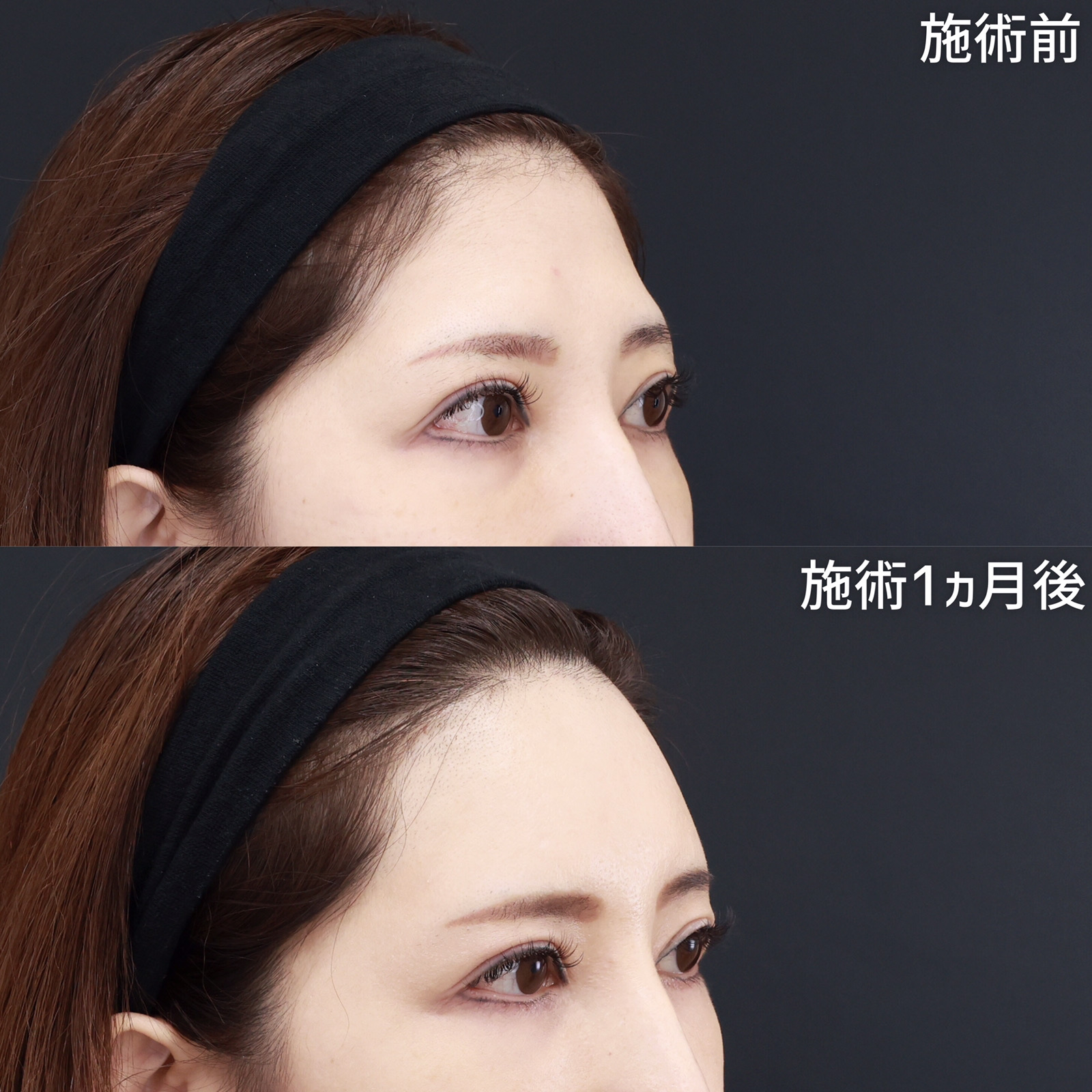 おでこの脂肪注入（オルチャンデコ形成）/顔の脂肪注入(コンデンスリッチフェイス)の症例写真 施術前後 