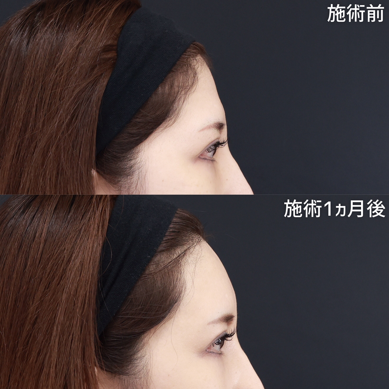 おでこの脂肪注入（オルチャンデコ形成）/顔の脂肪注入(コンデンスリッチフェイス)の症例写真 施術前後 