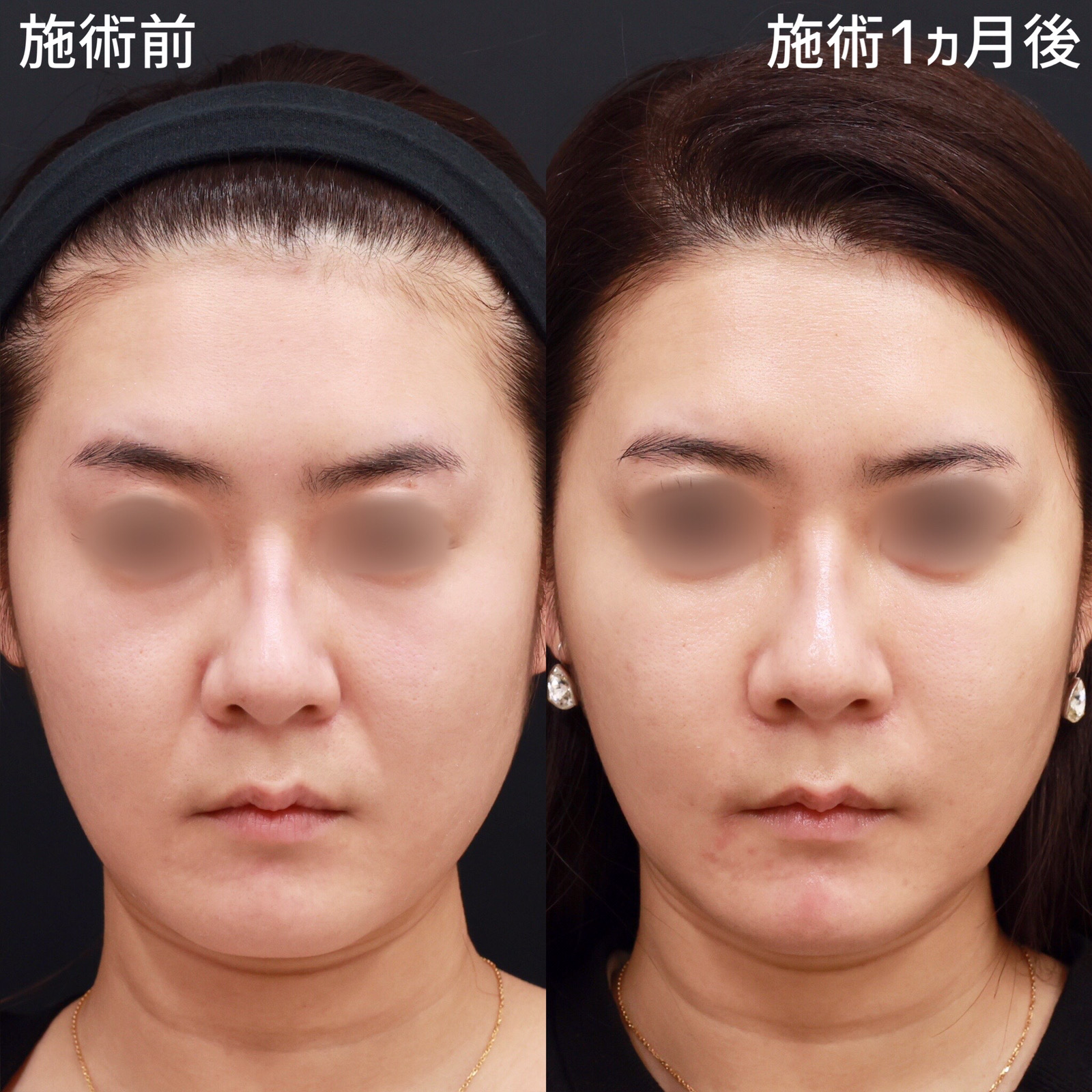 【顔の脂肪注入】目の下のクマとほうれい線は、アンチエイジングの基本！