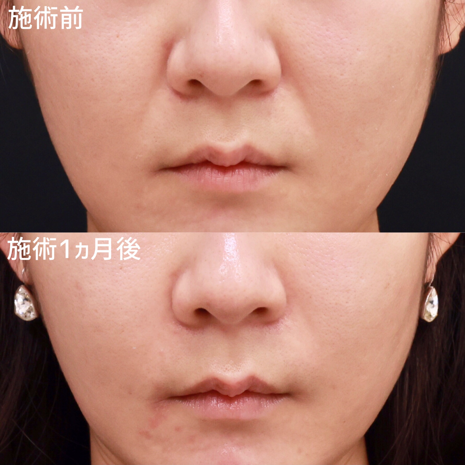 下眼瞼脱脂術（目の下のたるみ取り・目の下の脂肪ふくらみ取り）/顔の脂肪注入(コンデンスリッチフェイス)の症例写真 施術前後 1ヵ月