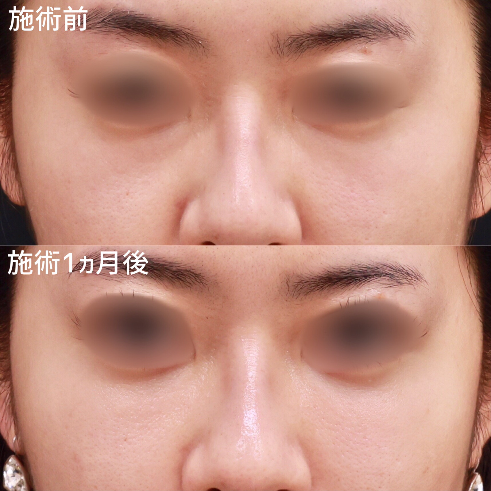 下眼瞼脱脂術（目の下のたるみ取り・目の下の脂肪ふくらみ取り）/顔の脂肪注入(コンデンスリッチフェイス)の症例写真 施術前後 1ヵ月