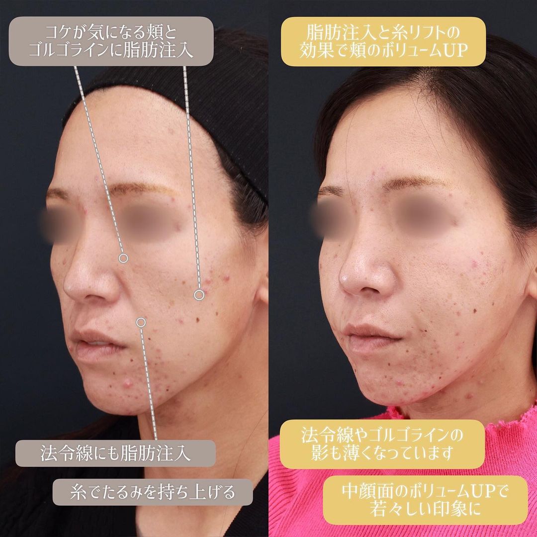 TAC式 ツヤ肌コラーゲンリフト®/エラボトックス注射/顔の脂肪注入(コンデンスリッチフェイス)の症例写真 施術前後 