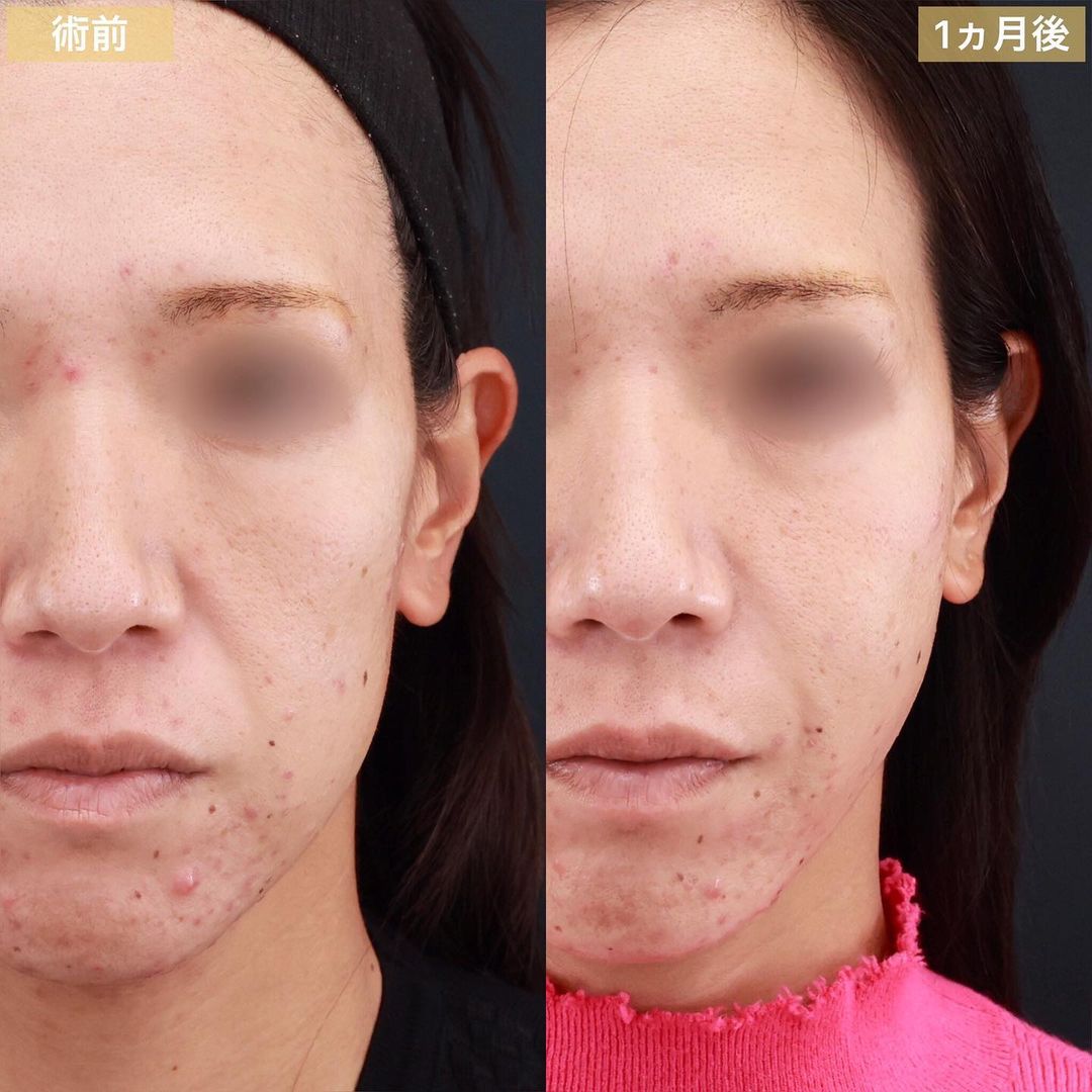 TAC式 ツヤ肌コラーゲンリフト®/エラボトックス注射/顔の脂肪注入(コンデンスリッチフェイス)の症例写真 施術前後 