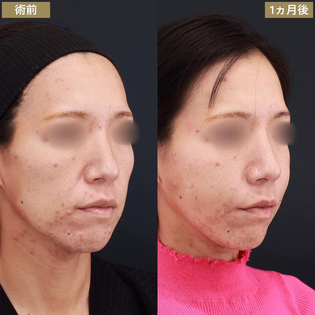 TAC式 ツヤ肌コラーゲンリフト®/エラボトックス注射/顔の脂肪注入(コンデンスリッチフェイス)の症例写真 施術前後 