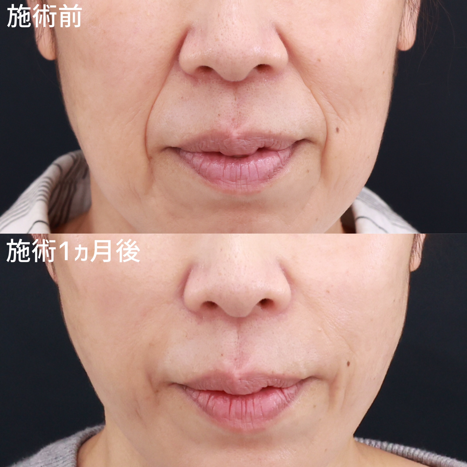 顔の脂肪注入(コンデンスリッチフェイス)/ジョールファット除去/TAC式 ツヤ肌コラーゲンリフト®の症例写真 施術前後 