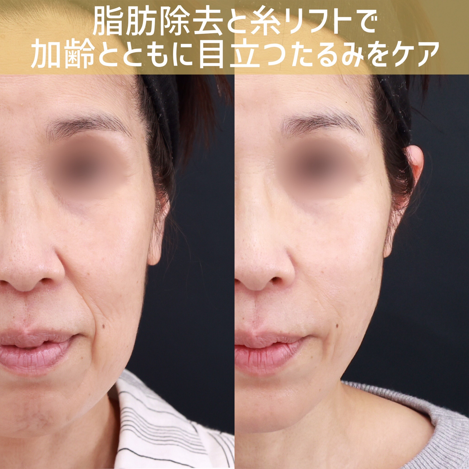 顔の脂肪注入(コンデンスリッチフェイス)/ジョールファット除去/TAC式 ツヤ肌コラーゲンリフト®の症例写真 施術前後 