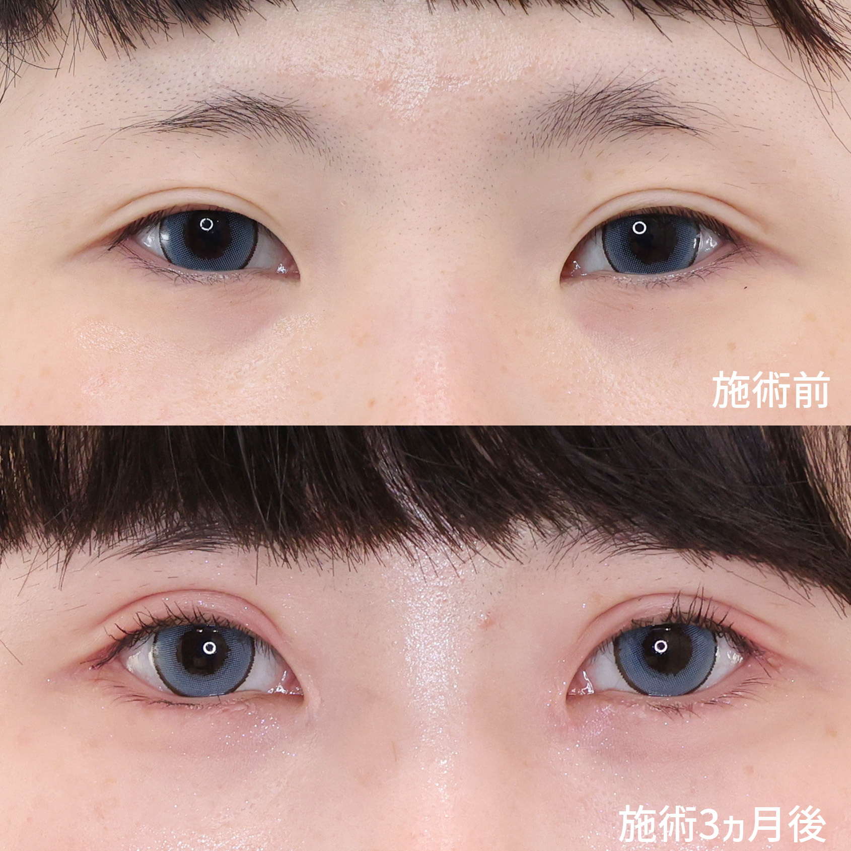 憧れのパッチリ大きな”愛され系”のお目元に!