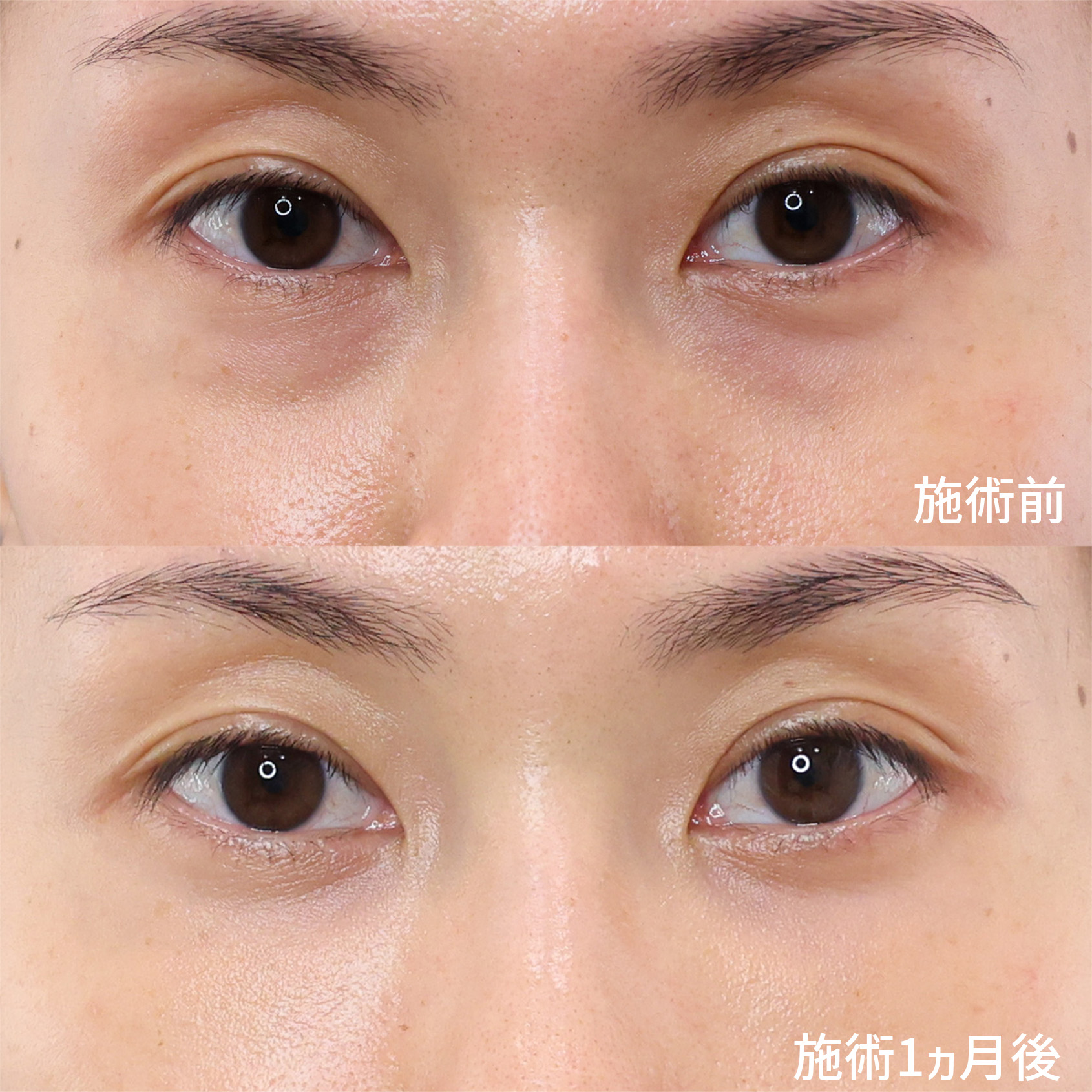 下眼瞼脱脂術(目の下のたるみ取り・目の下の脂肪ふくらみ取り)/顔の脂肪注入(コンデンスリッチフェイス)の症例写真 施術前後