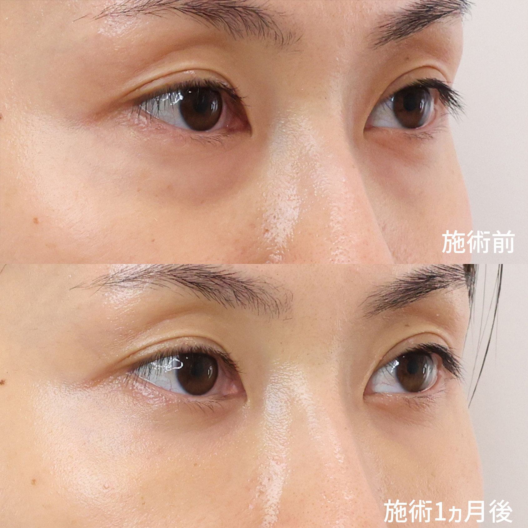 下眼瞼脱脂術(目の下のたるみ取り・目の下の脂肪ふくらみ取り)/顔の脂肪注入(コンデンスリッチフェイス)の症例写真 施術前後