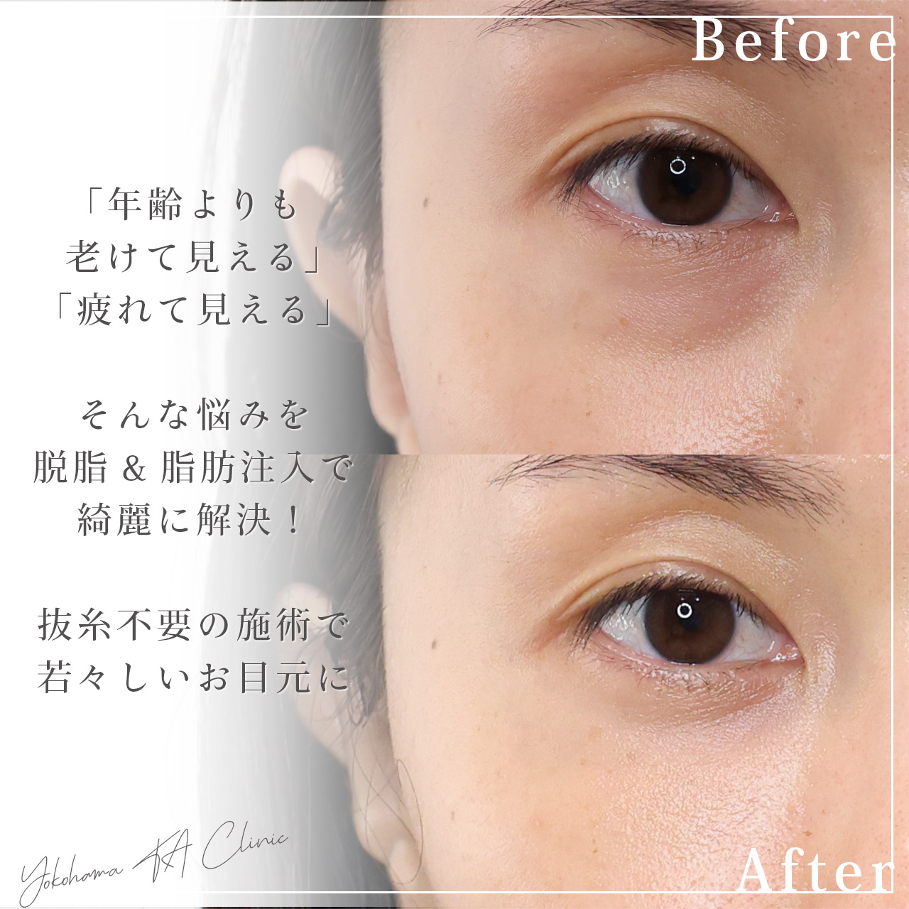 下眼瞼脱脂術(目の下のたるみ取り・目の下の脂肪ふくらみ取り)/顔の脂肪注入(コンデンスリッチフェイス)の症例写真 施術前後