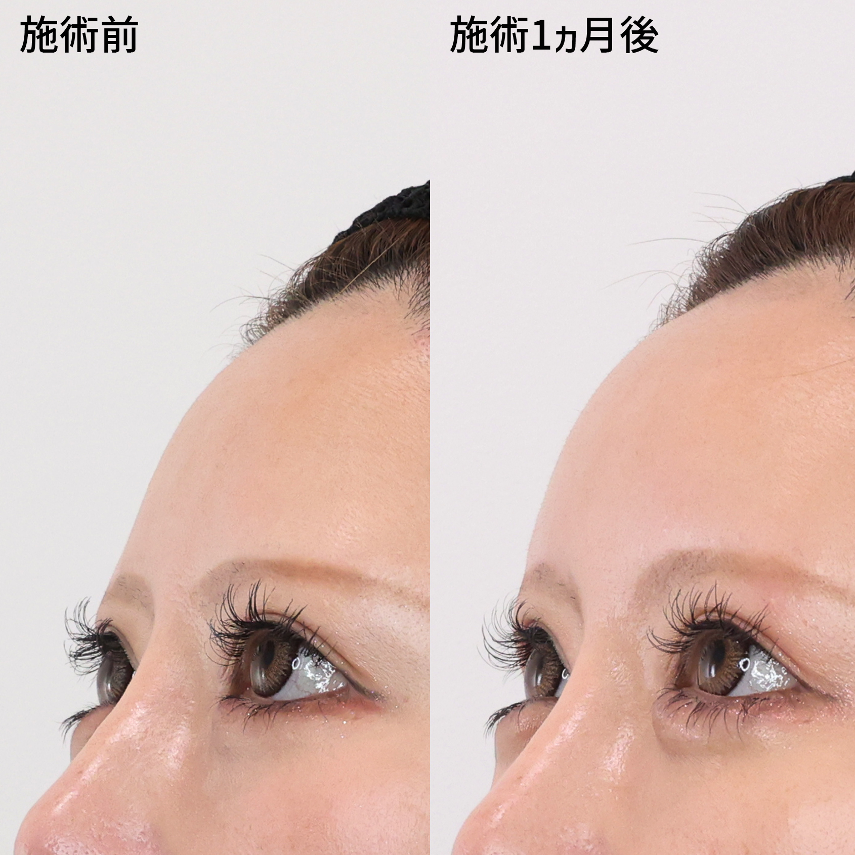 丸みのあるおでこで変わる印象！女性らしい美しいフェイスラインへ！！【オルチャンデコ形成】