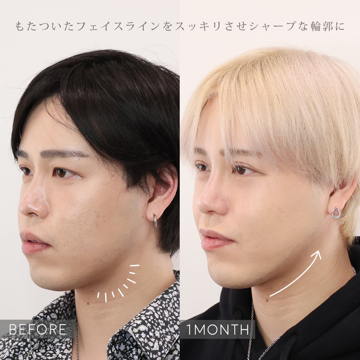 小顔整形｜パーフェクトフェイスライン/TAC式 ツヤ肌コラーゲンリフト®/バッカルファット除去の症例写真 施術前後 