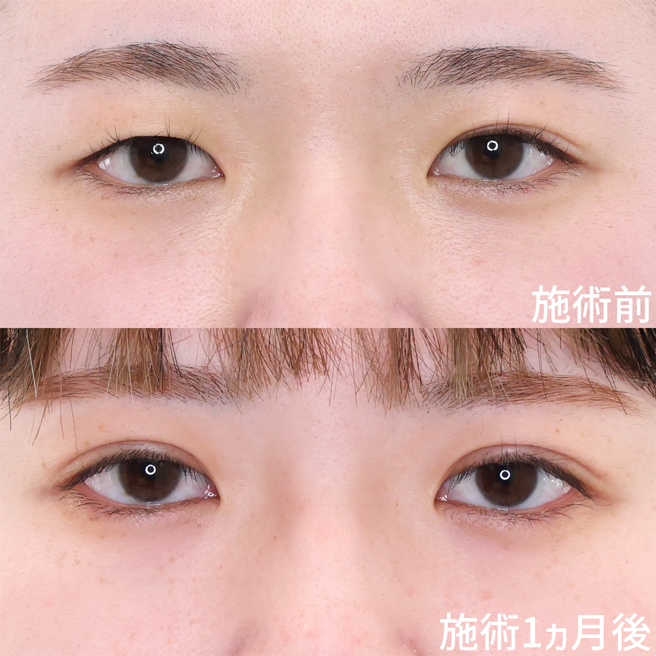 毎日の二重のりを卒業。初めての方も安心の二重埋没法