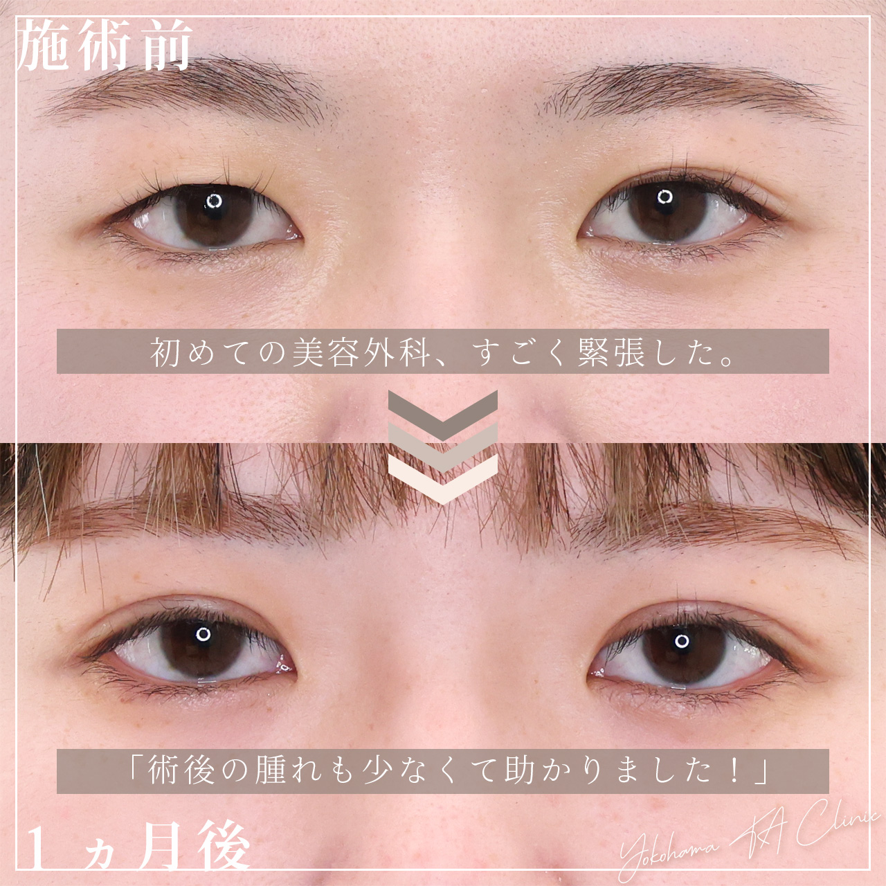 二重埋没法の症例写真 施術前後 