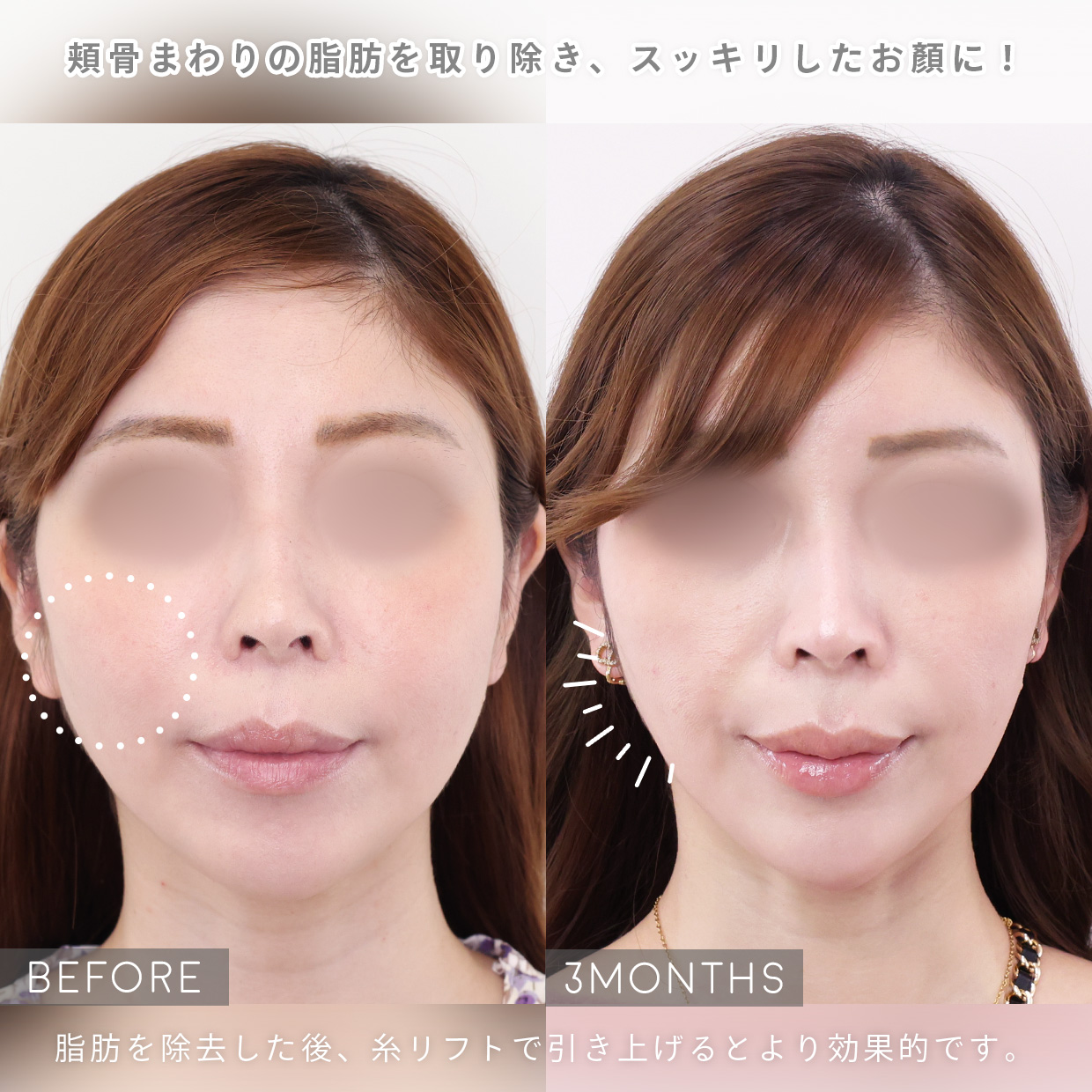 TAC式 ツヤ肌コラーゲンリフト®/メーラーファット除去/顎のヒアルロン酸注射の症例写真 施術前後 