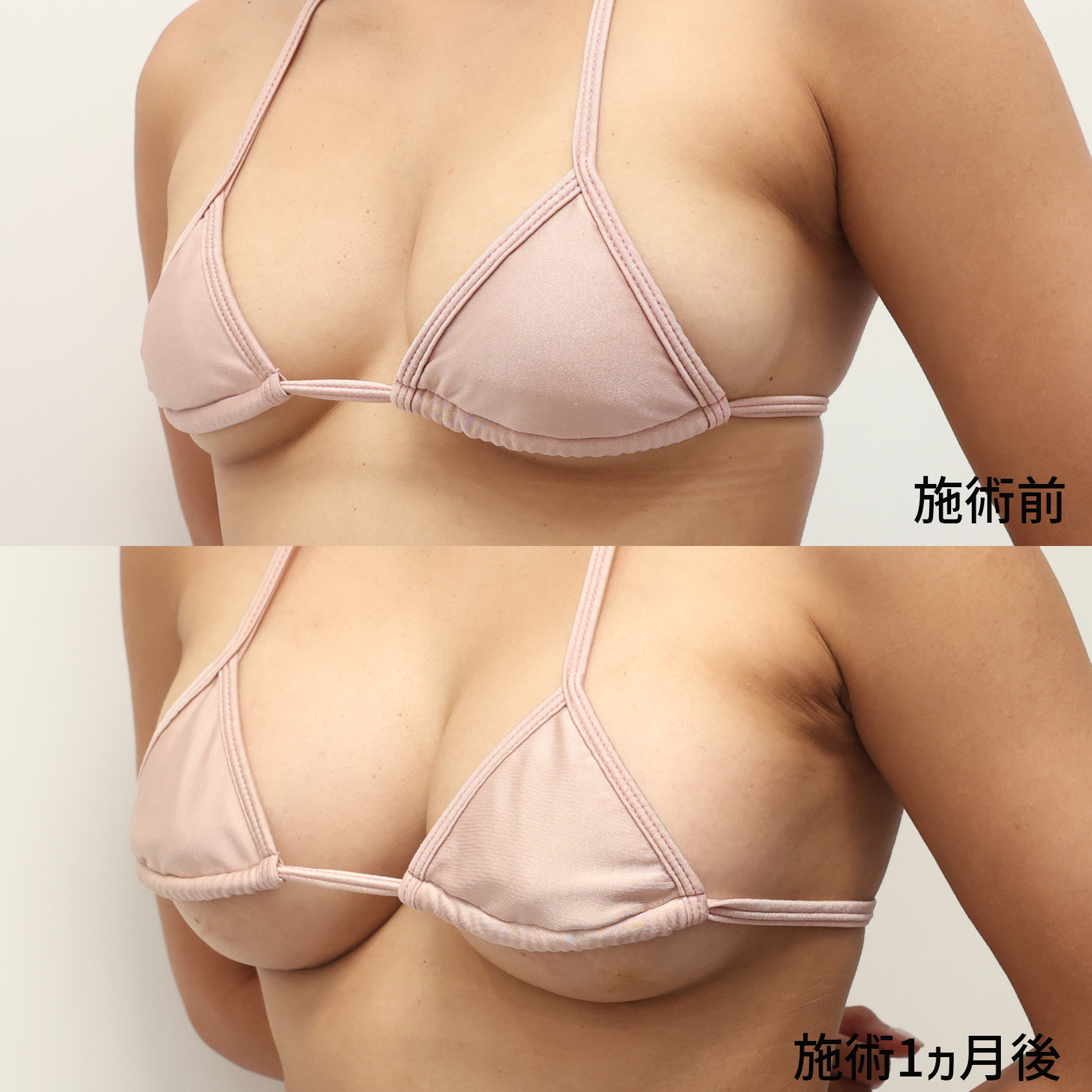 シリコンバッグ豊胸(人工乳腺バッグ)の症例写真 施術前後 1ヵ月