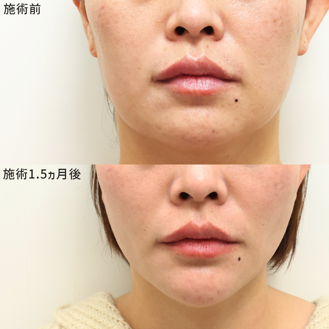 別人級の小顔効果が欲しいならＤr.MARIE