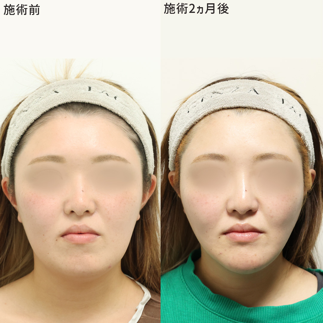 圧倒的な小顔効果が欲しいなら【パーフェクトフェイスライン】