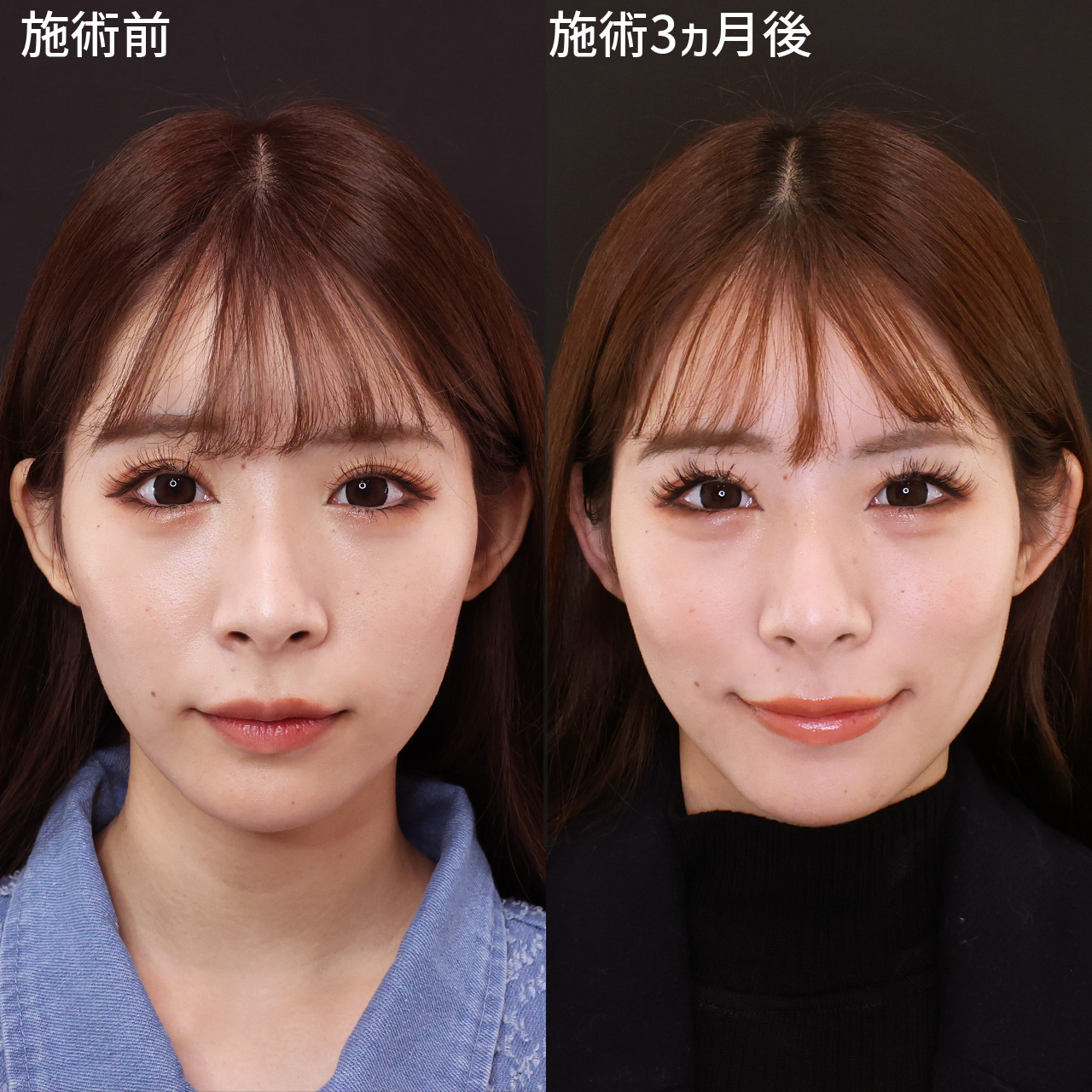 ジョールファット除去/TAC式 ツヤ肌コラーゲンリフト®/エラボトックス注射の症例写真 施術前後