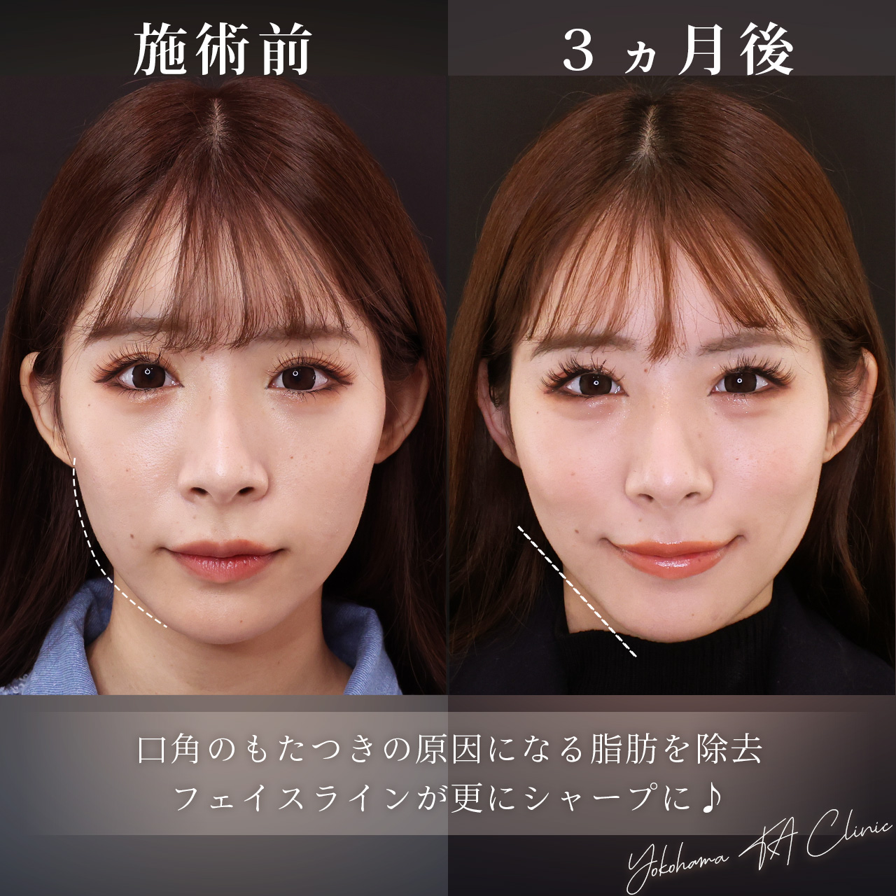 ジョールファット除去/TAC式 ツヤ肌コラーゲンリフト®/エラボトックス注射の症例写真 施術前後