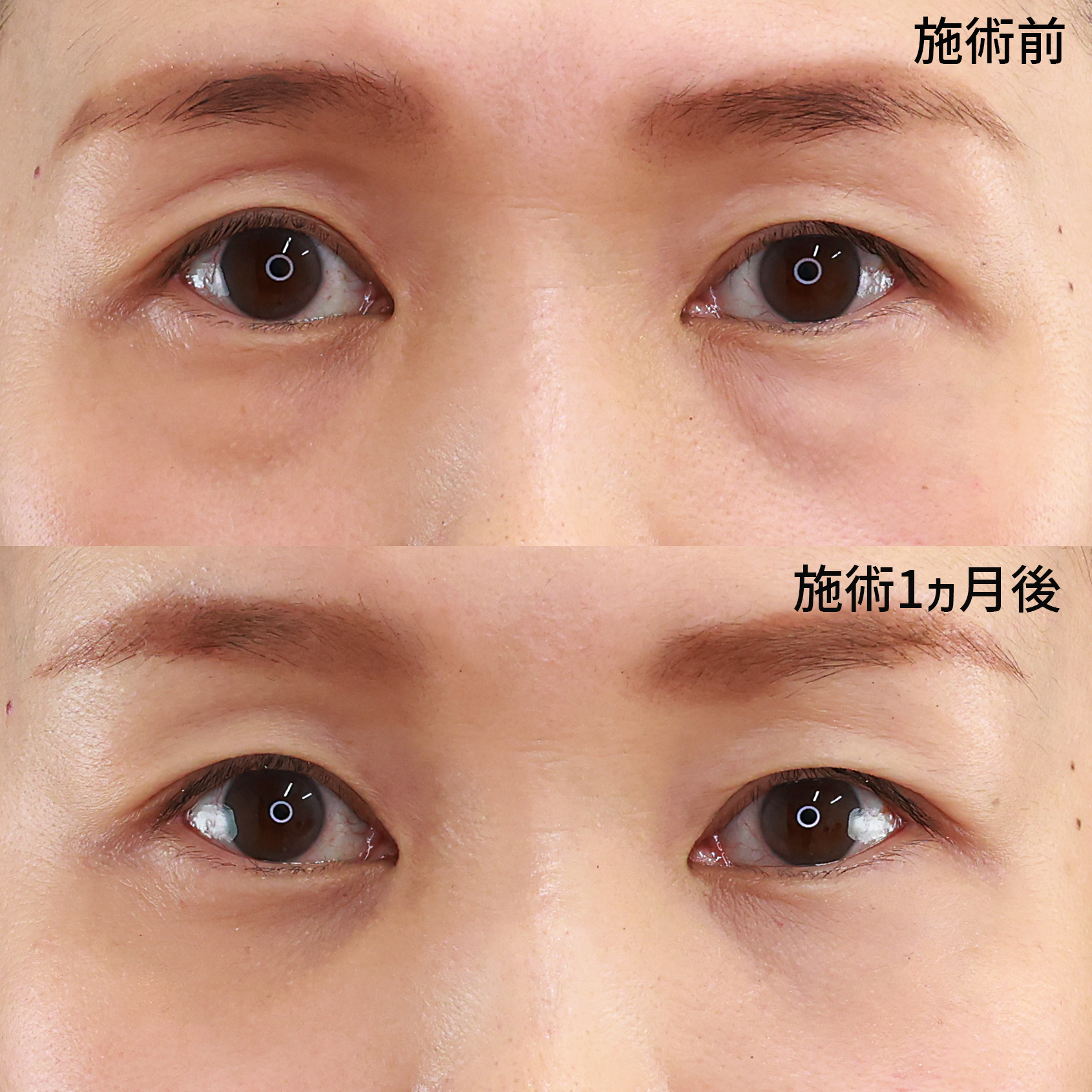 疲れ顔とは言わせない！目の下のふくらみ除去×脂肪注入で、自信が持てる目元へ