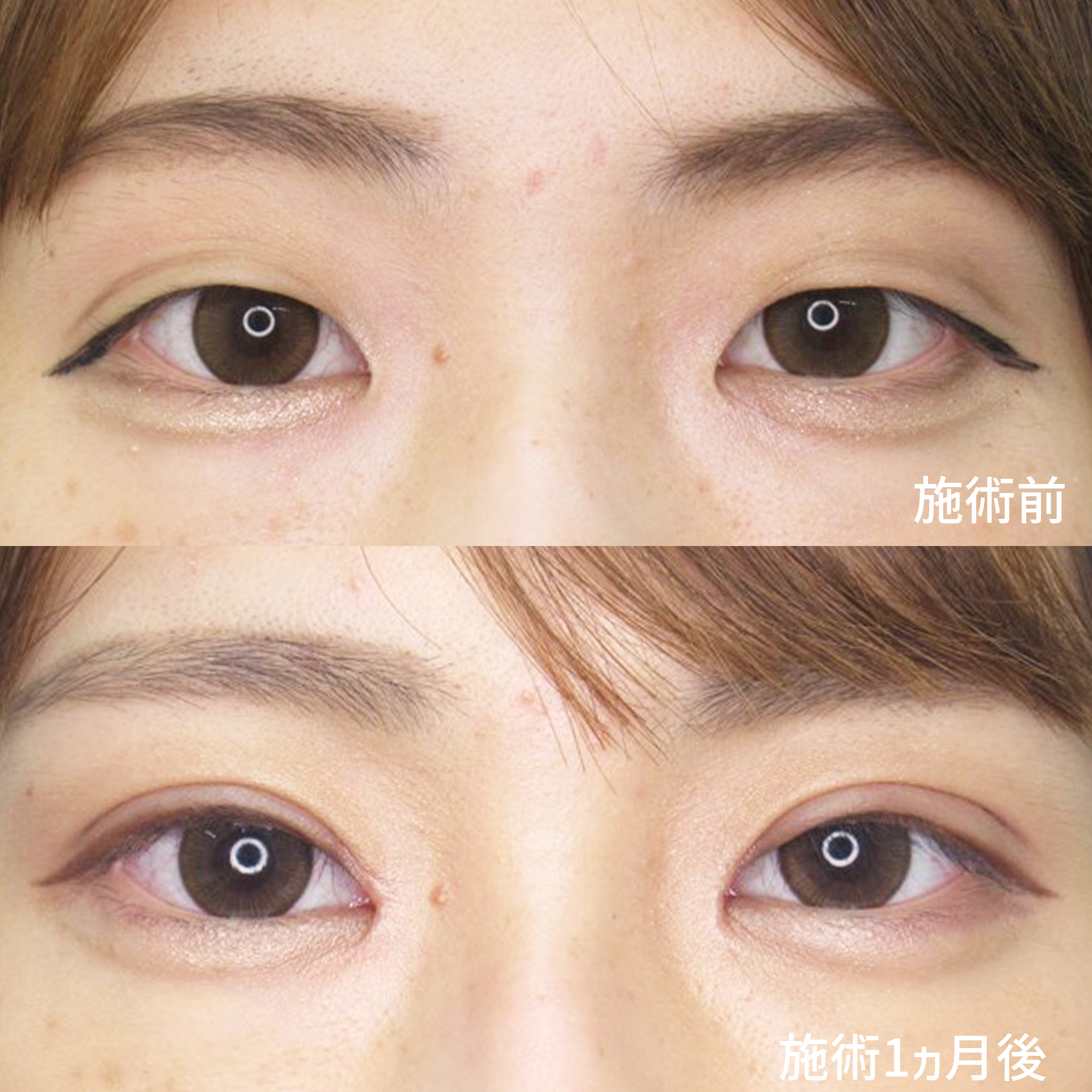 全切開法と目頭切開術ｗで憧れの平行二重へ