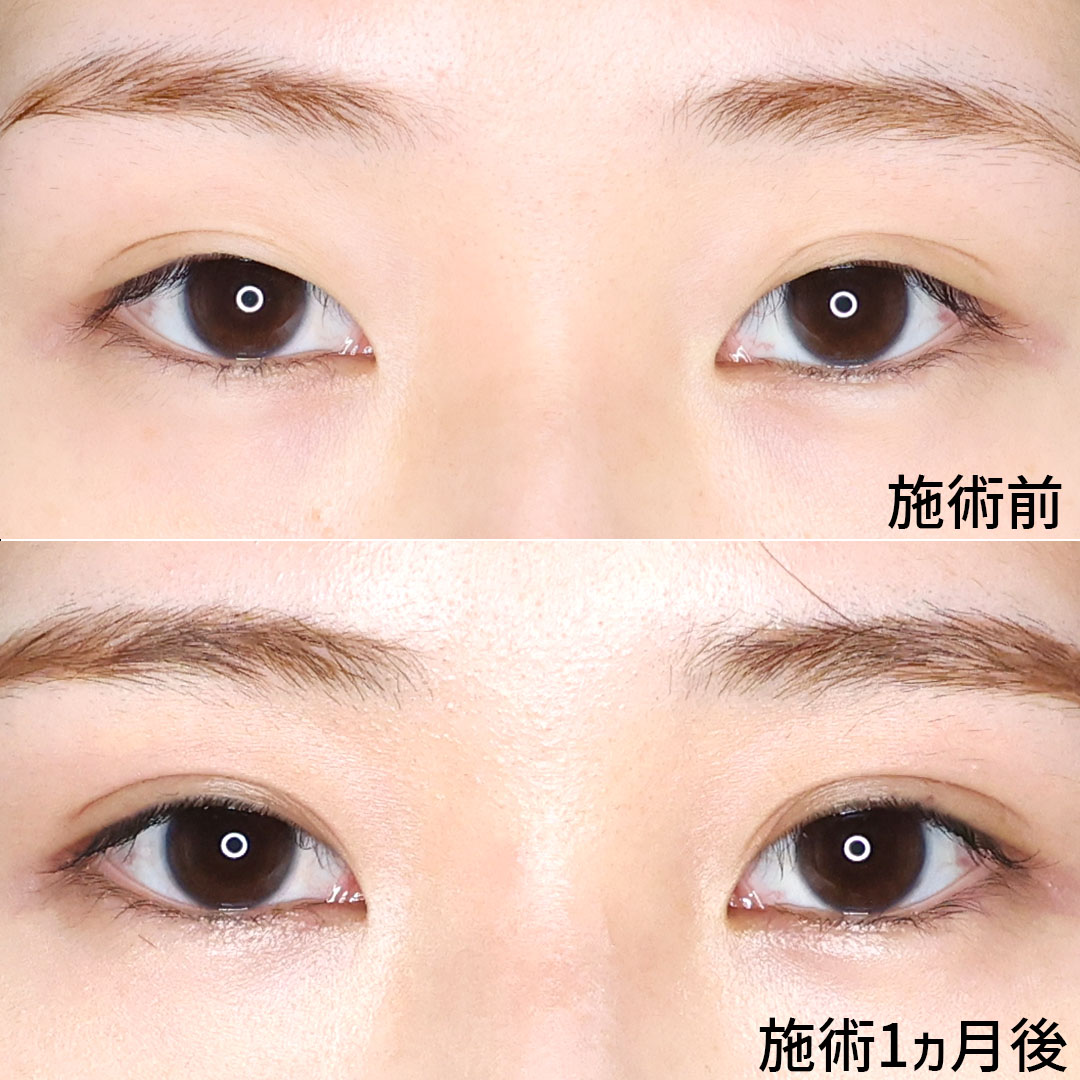 二重埋没法の症例写真 施術前後 