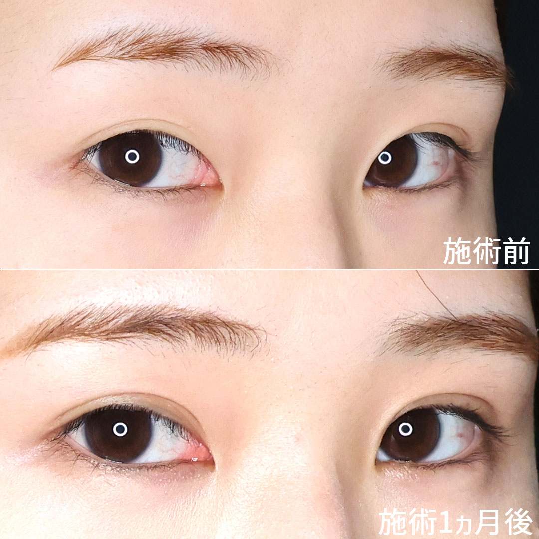 二重埋没法の症例写真 施術前後 