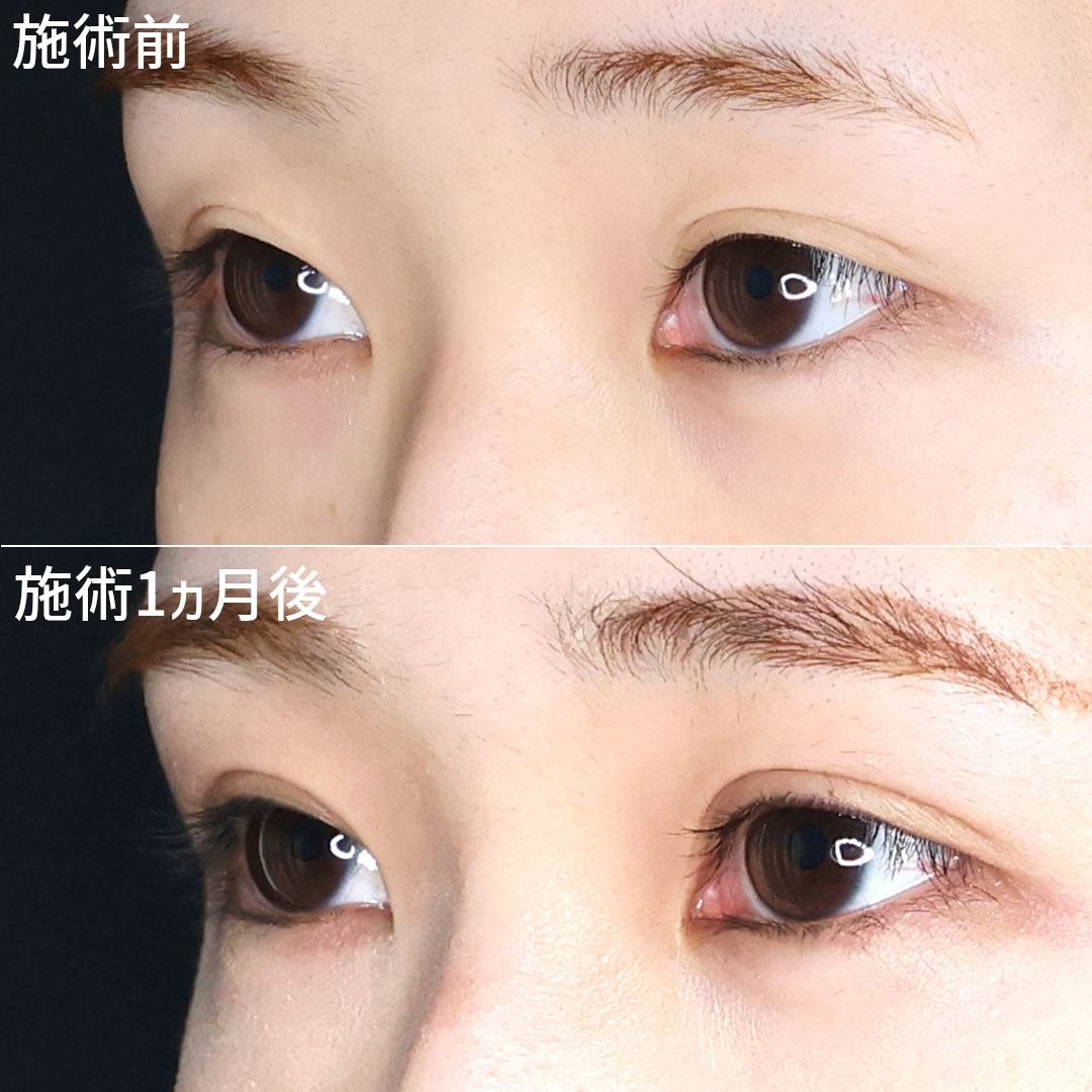 二重埋没法の症例写真 施術前後 