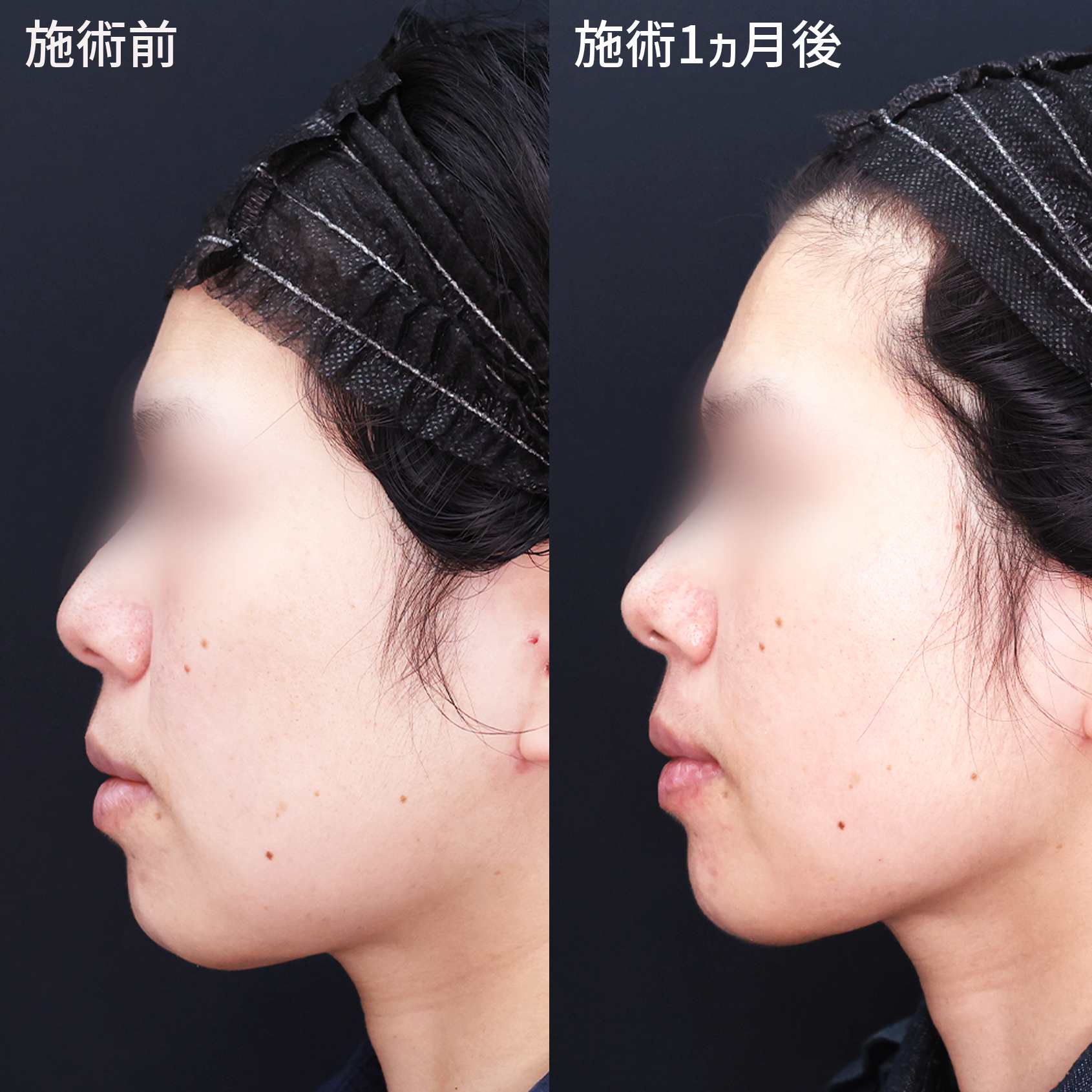 複合施術で理想のスッキリとした輪郭を！