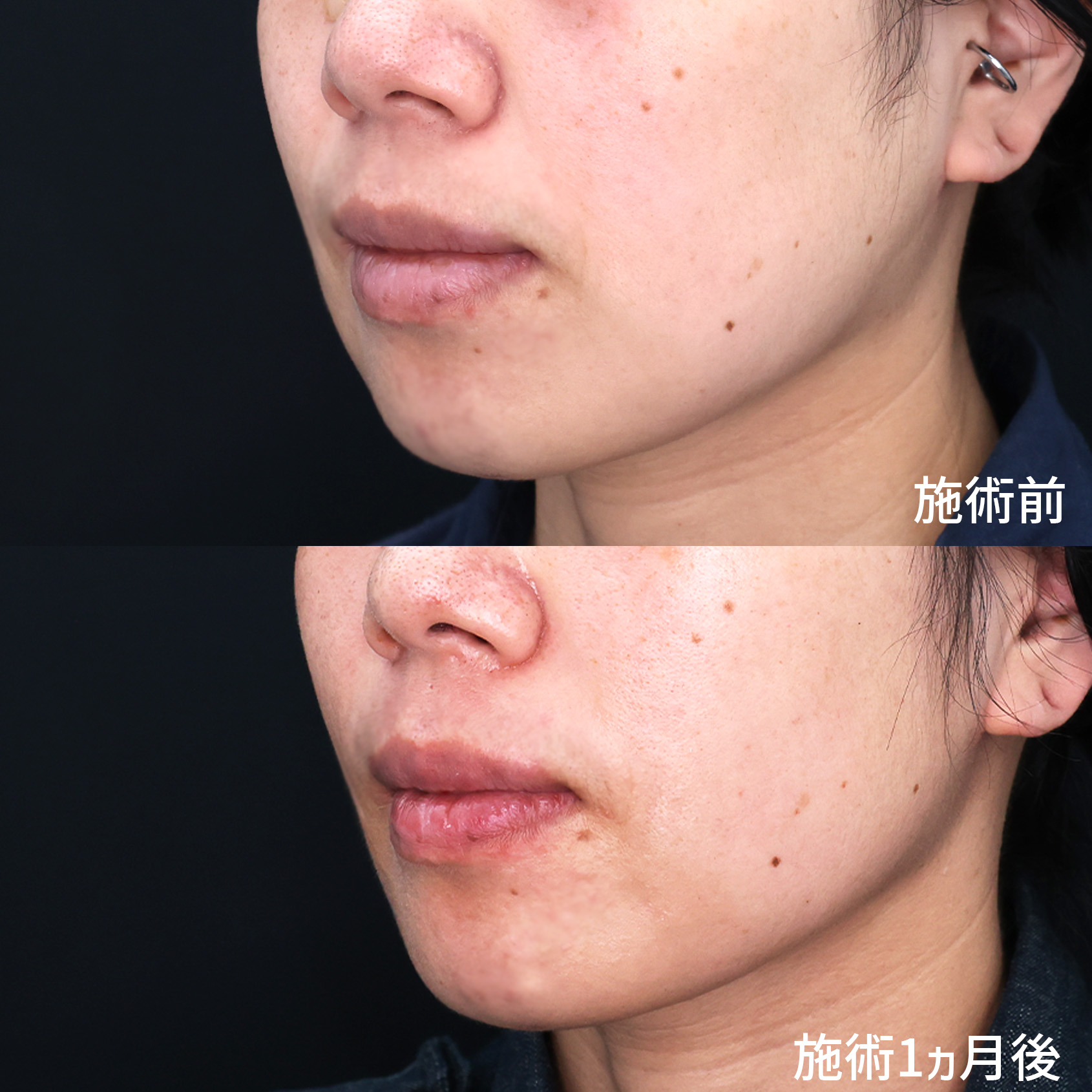 TAC式 ツヤ肌コラーゲンリフト®/ジョールファット除去/メーラーファット除去の症例写真 施術前後 