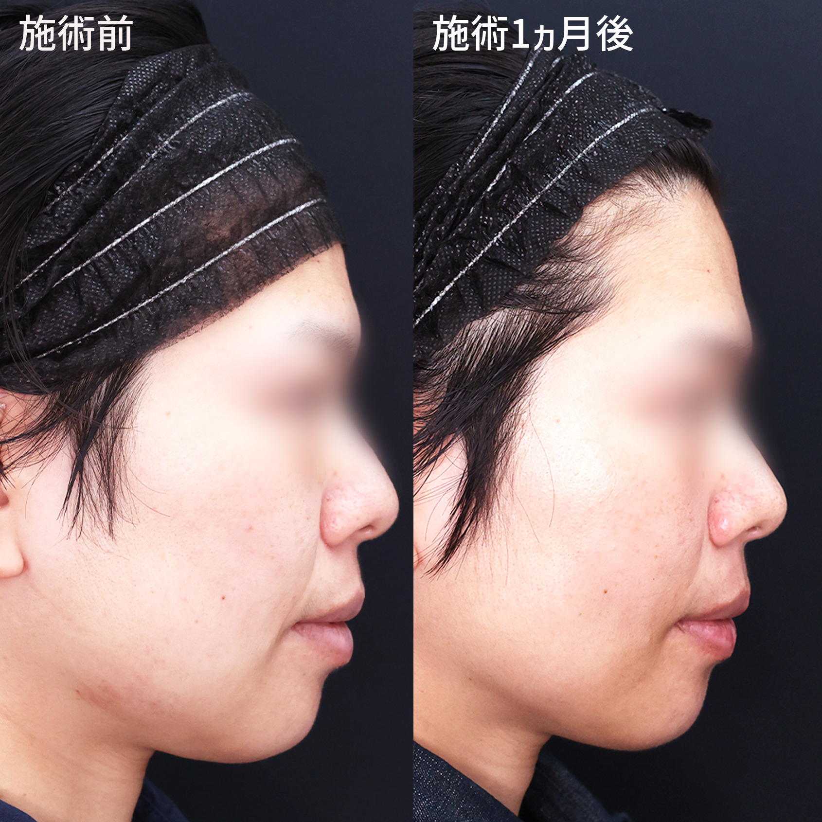 TAC式 ツヤ肌コラーゲンリフト®/ジョールファット除去/メーラーファット除去の症例写真 施術前後 