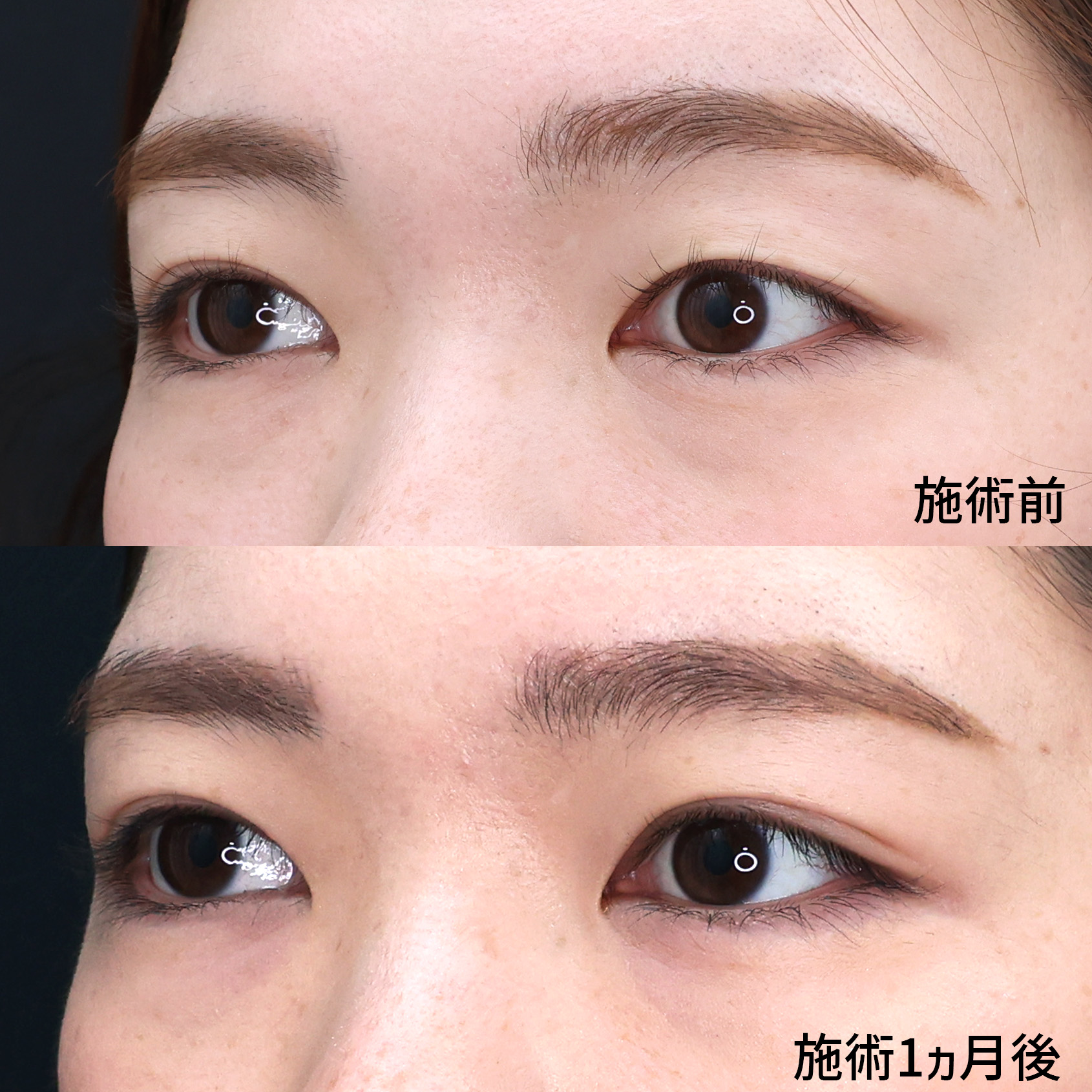 片目二重術（片目だけ整形したい方）/二重埋没法の症例写真 施術前後 