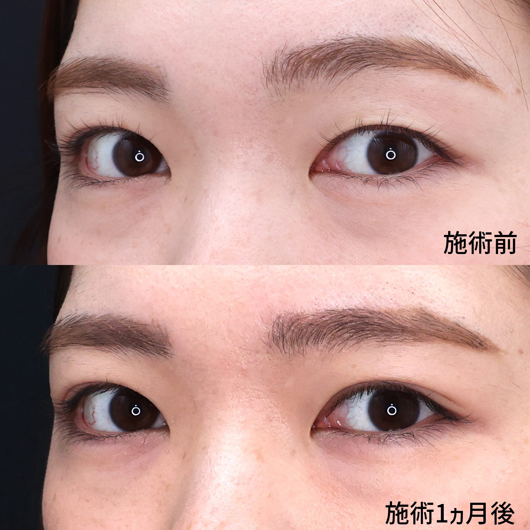 片目二重術（片目だけ整形したい方）/二重埋没法の症例写真 施術前後 