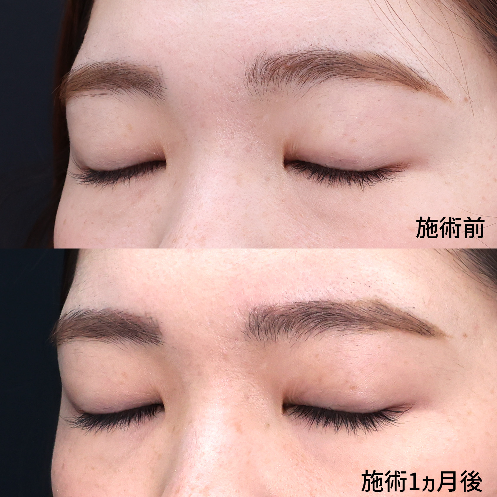 片目二重術（片目だけ整形したい方）/二重埋没法の症例写真 施術前後 