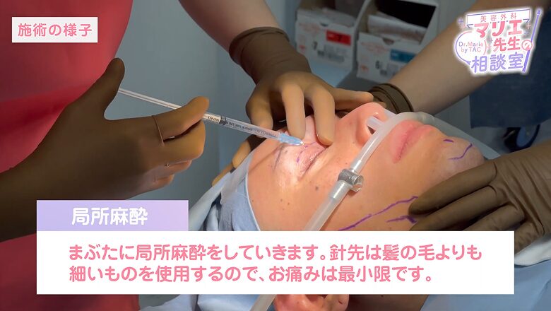 まぶたへ局所麻酔を注射している施術の様子