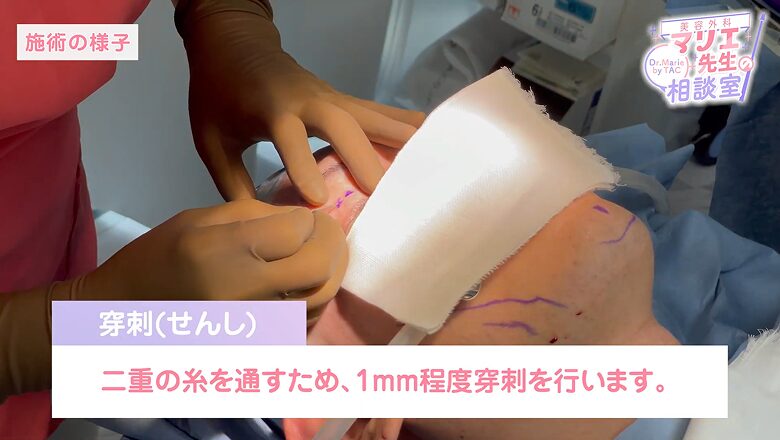 まぶたへ1mm程度の穿刺を行う施術の様子