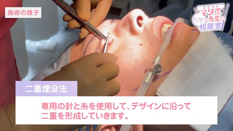 専用の針と糸で二重を形成する埋没法の施術
