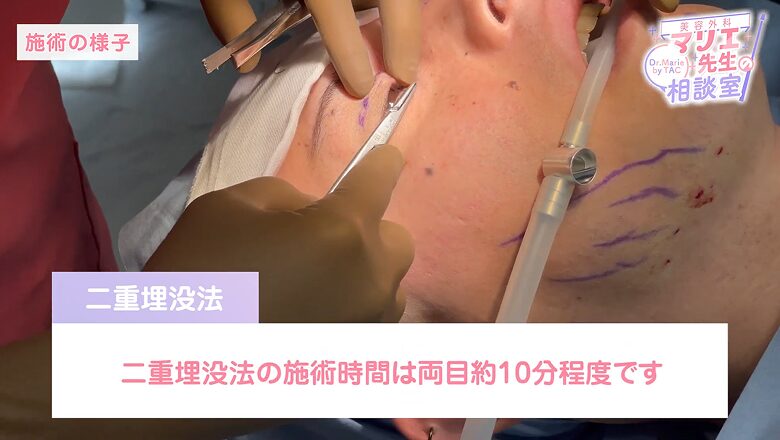 両目約10分で完了する二重埋没法の施術風景